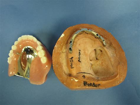 Implant Bars Zedan Dental Lab