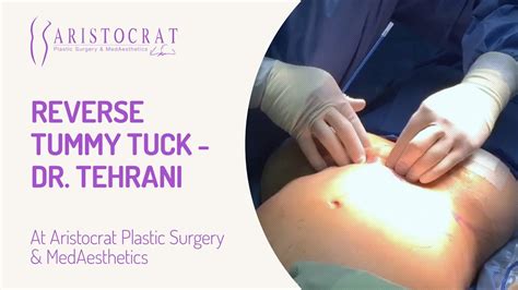 Reverse Tummy Tuck Dr Tehrani Youtube