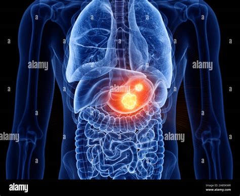 Radiografía De Cáncer De Esófago