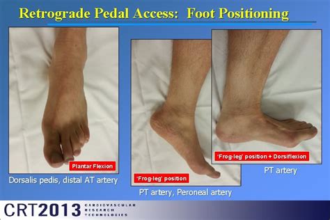 Peripheral Arterial Disease Critical Limb Ischemia Pedal Approach