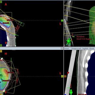 Accelerated Partial Breast Irradiation Apbi Multicatheter