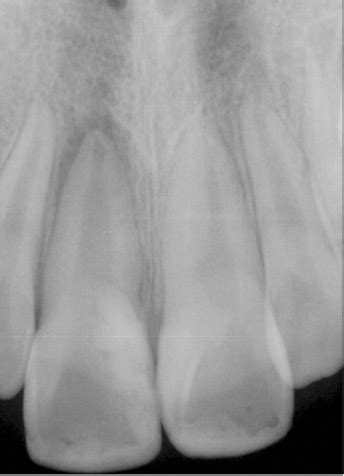 Initial radiograph. Periapical lesion was observed. | Download Scientific Diagram