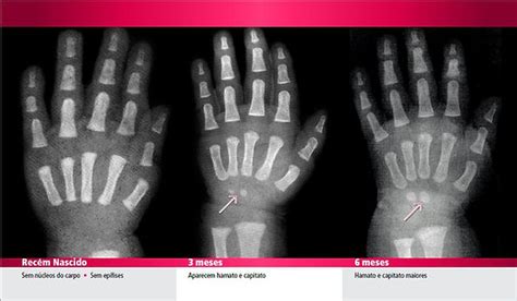 RX para cálculo da Idade Óssea Raio X