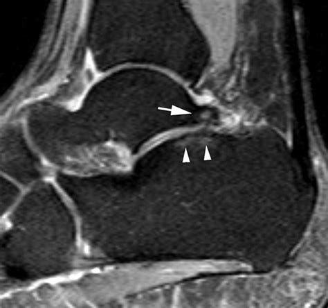 Mr Imaging Of Ankle Impingement Syndromes Ajr