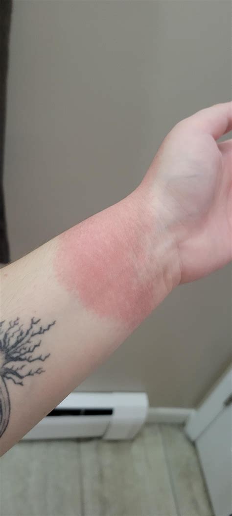 Help with this rash? I think it's eczema? : r/EczemaSupport