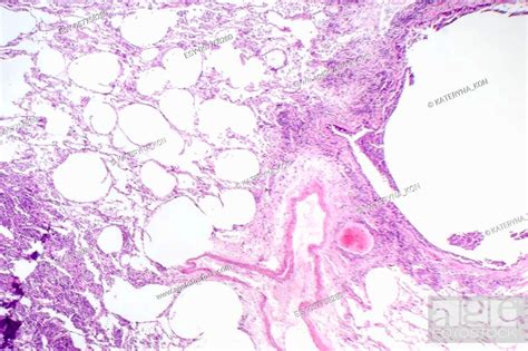 Histopathology Of Interstitial Pneumonia Light Micrograph Stock Photo