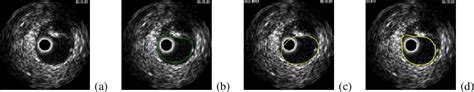 Figure 1 From Shape Driven Segmentation Of The Arterial Wall In Intravascular Ultrasound Images