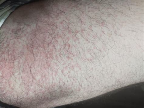 Rash In Inner Thigh Warm And Itchy Rdiagnoseme