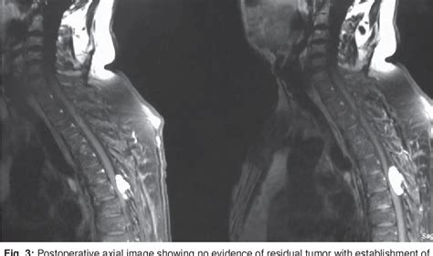 Figure From A Rare Case Of Dumbbell Shaped Spinal Epidural Capillary