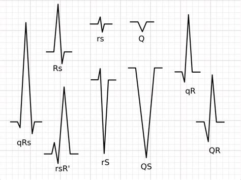 File QRS Nomenclature Svg Qrs Complex Cardiology Bundle Branch Block