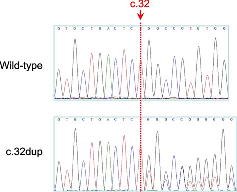 Sanger Sequencing Electropherogram Showing The Heterozygous