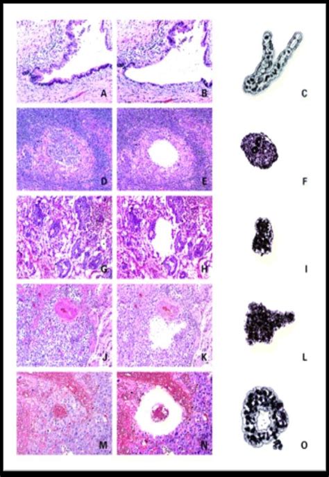 Histological Images Of Metastatic Germ Cell Tumour In Retroperitoneal