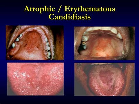 PPT Oral Manifestations Of Systemic Diseases PowerPoint Presentation