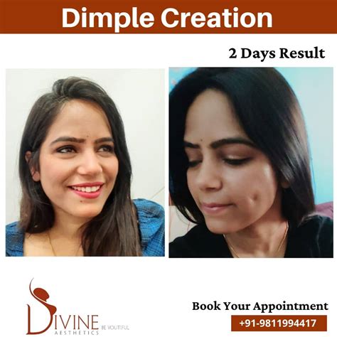 How To Get Dimples On Face? Dimple Surgery Cost