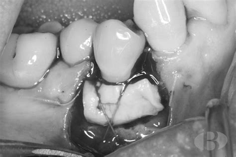 Tratamiento de una recesión gingival en un primer premolar inferior