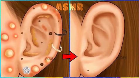 Ear Pimple Pimples Asmr Animation The Creator Pop Art Care