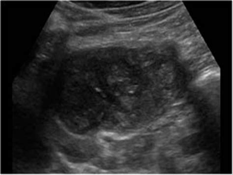 Abdomen And Retroperitoneum Liver Case Hydatid Cysts