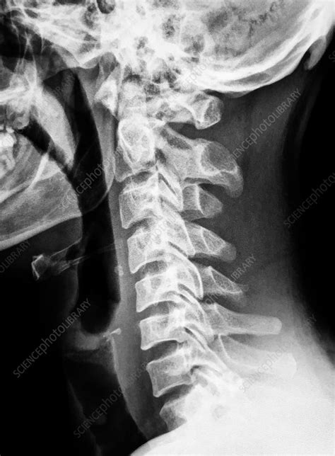 Normal Cervical Spine, X-Ray - Stock Image - C039/3923 - Science Photo Library