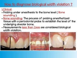 Biological width | PPT | Free Download