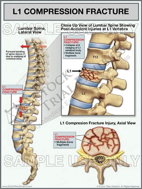 Compression fracture – Artofit