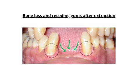 Bone Loss After Tooth Extraction Rates Risks And Consequences