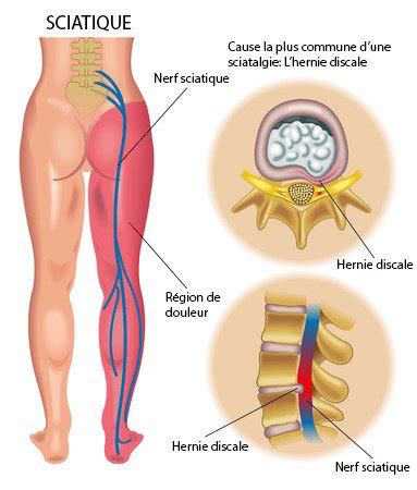 Sténose Spinale Causes symptômes et traitement Chiro à Québec