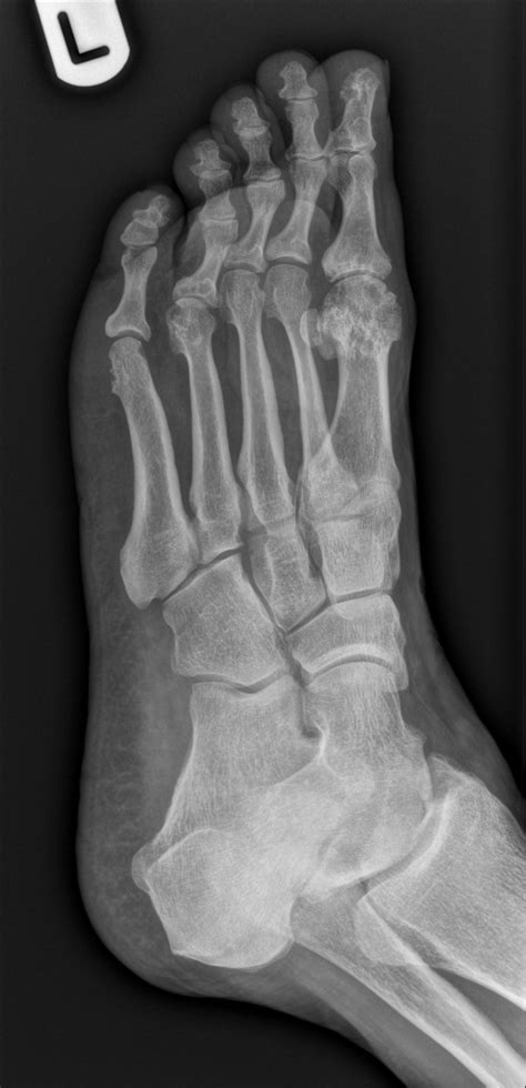 Rheumatoid Arthritis Feet Image