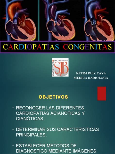 Cardiopatías Congénitas Kry Pdf Defecto Cardiaco Congenito