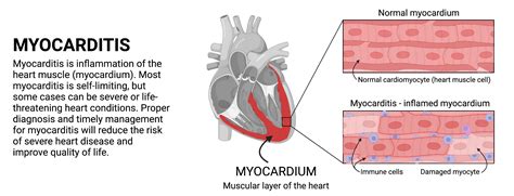 Myocarditis Center Ucsf Cardiology