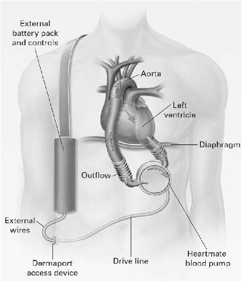 Example Of A Portable Left Ventricular Assist Device Reprinted With