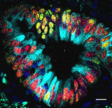 Scientists Find Stomach Cells In Lung Cancer Duke University School Of Medicine