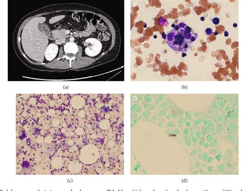 Figure 1 From Hemophagocytic Lymphohistiocytosis Secondary To Disseminated Histoplasmosis In