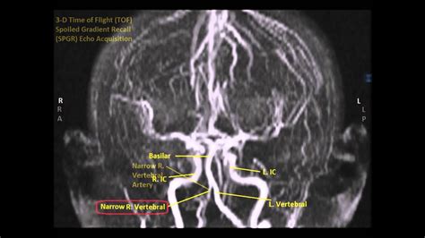 Abnormal Right Vertebral Artery 3 D MRA Sequence Sanjoy Sanyal YouTube