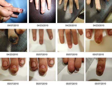 SpaceAge Fingertip Regeneration - Stem Cell Activation Therapy