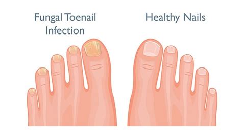 Fingernail and Toenail Pain – Symptoms, Causes and Treatments – Page 3 ...