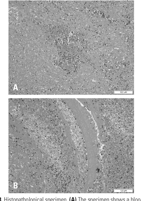 Figure 3 From Spontaneous Cervical Spinal Epidural Hematoma Mimicking