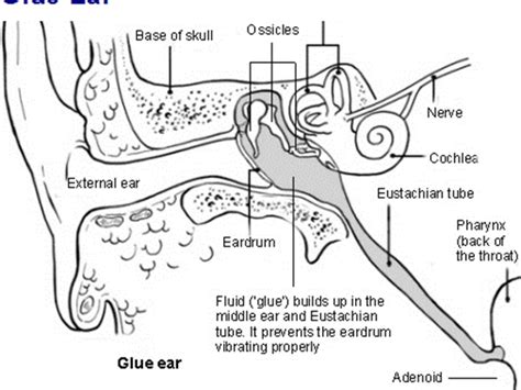 Boil (Furuncle) In The Ear Canal , ENT Consultant London MR Kiran ...