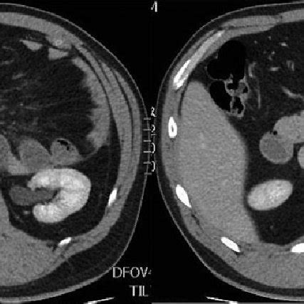 (1-4) Identification and laparoscopic reduction of paraduodenal hernia ...