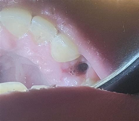 is this healing good? : r/DentalSchool 