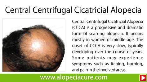 scarring alopecia treatment