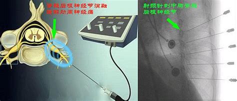 市三醫院神經內科二科成功開展首例經皮穿刺肋間神經射頻消融術 每日頭條