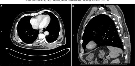 Figure From Staphylococcus Lugdunensis Abscess With Deep Tissue