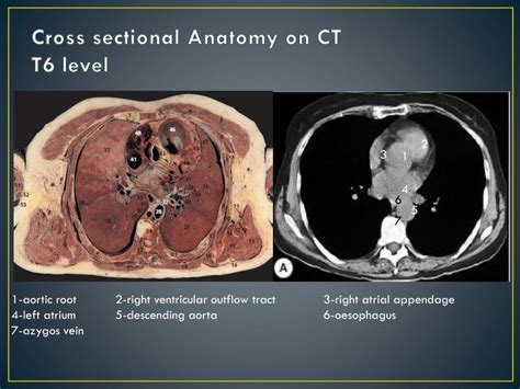 Ppt Imaging Anatomy Of The Mediastinum Powerpoint Presentation Id2075433