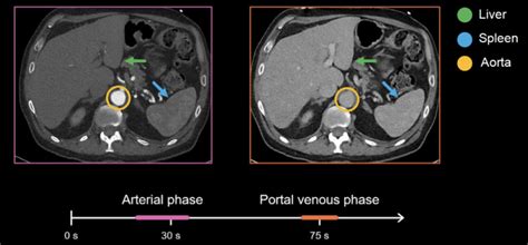 Abdominal Ct Phases • Litfl • Radiology Library