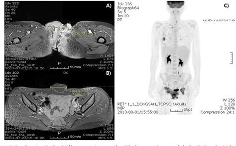 Figure 2 From A Proximal Type Epithelioid Sarcoma Of The Vulva With