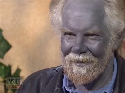 Paul Karason Dies; Medical Mystery Known as "Blue Man" or "Papa Smurf ...