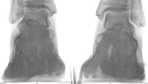 Fracture of Sesamoid - OC Podiatry