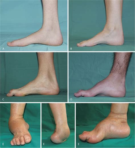 Charcot Marie Tooth Disease Treatment Charcot Tooth Disease Marie