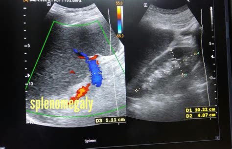 Ultrasound imaging: Nodular-cirrhosis-liver