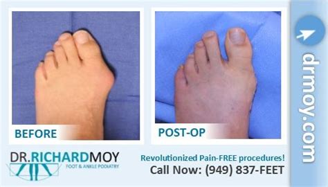 Dr Richard Moy DPM Painless Bunion Surgery Board Certified Surgeon